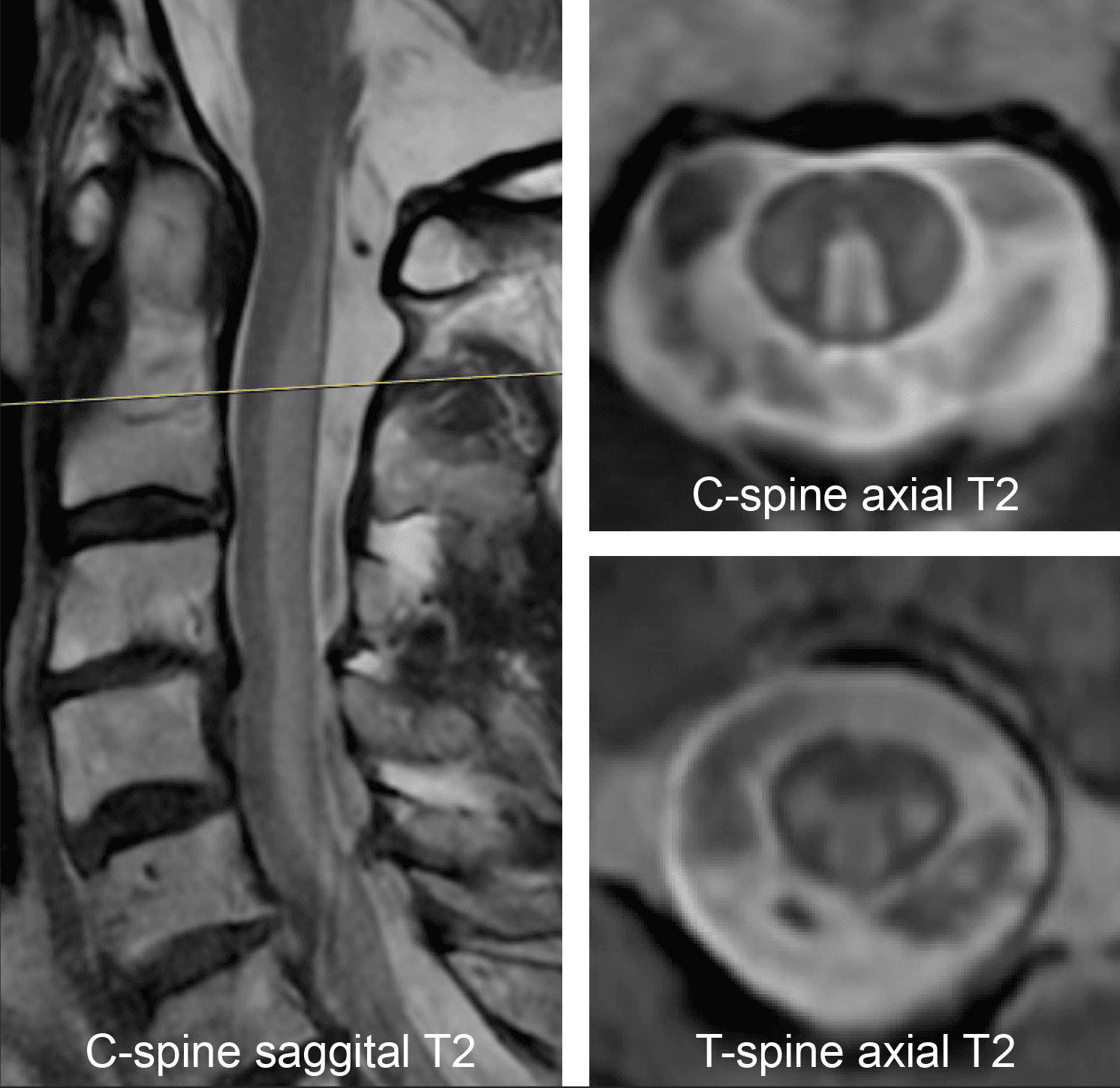 Anti-CD320 autoantibodies and central nervous system vitamin B12 deficiency in idiopathic myelopathy
